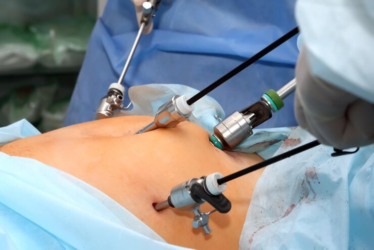 Laparoscopic Kidney Stone Removal